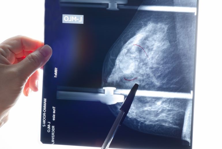 Mammogramm-Röntgenaufnahme der Brust mit Händen, die das Bild halten.