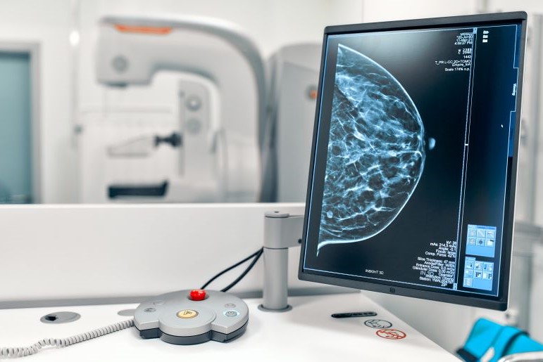 Mammographie-Bildschirm zeigt Brustaufnahme für Früherkennung. Im Hintergrund Mammographie-Gerät.