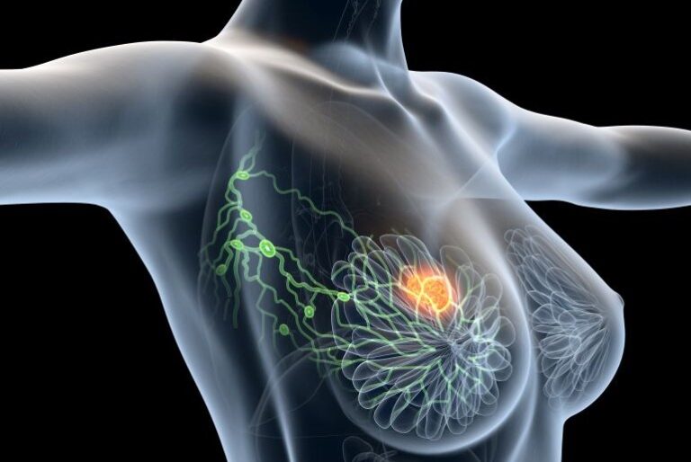 Medizinische 3D-Darstellung des Brustbereichs mit Lymphknoten und Tumor, Fokus auf Brustkrebsdiagnose.
