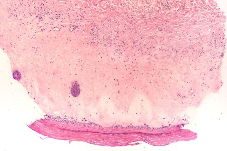 Subepidermale Sklerose und bandförmige Entzündung bei Lichen sclerosus unter dem Mikroskop, charakteristische Hautveränderung.